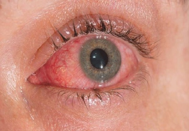 Conjunctivitis infection