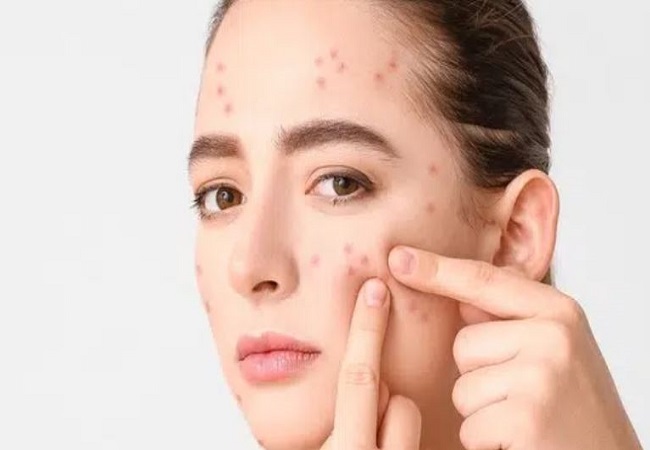 Pimples Problem: पसीने और गंदगी से चेहरे पर हो गए हैं पिंपल्स, तो इन टिप्स को फॉलो करके पाएं छुटकारा
