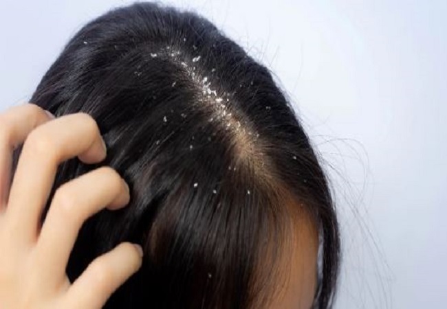 Dandruff Problems