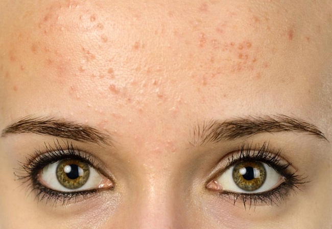 Forehead Pimples