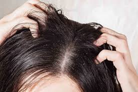 Dandruff problem solution: बदलते मौसम में डेंड्रफ को करना है टाटा बाय, एप्पल साइडर विनेगर का ऐसे करें इस्तेमाल