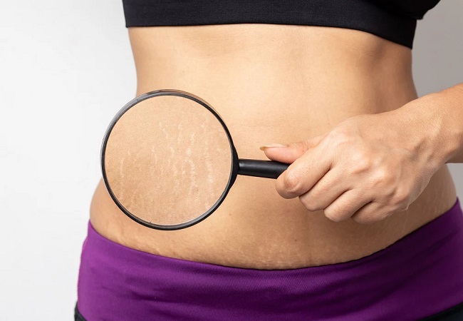 ways to get rid of stretch marks