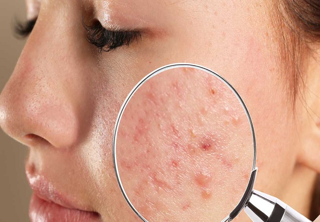 Skin care: चेहरे के दाग धब्बों से हैं परेशान तो इन चीजों को लगाने से मिलेगा छुटकारा