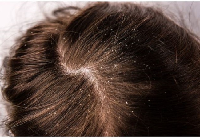 Dandruff Problem: ठंड आते ही शुरु हो जाती है डैंड्रफ और खुजली की दिक्कतें, तो फॉलो करें ये घरेलू नुस्खे