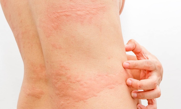 Skin allergies: शरीर में खुजली के साथ पड़ जाते है लाल चकत्ते या उछल आती है पित्ती, तो काम आएंगे ये घरेलू उपचार