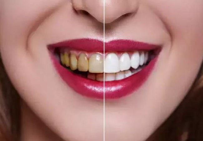 Oral health: दांतो को मोतियों जैसा चमकाने और मुंह से आने वाली गंदी बद्बू से छुटकारा पाने के लिए फॉलो करें ये नुस्खें