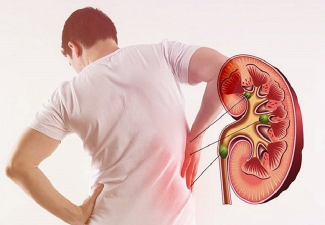 Kidney stones: अनजाने में इन चीजों का जरुरत से ज्यादा सेवन कर सकता है आपकी किडनी को बीमार, हो सकती है पथरी की समस्या