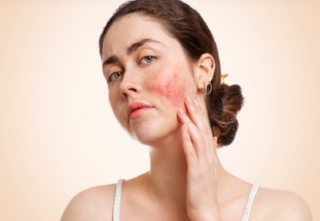Ways to get rid of burn marks: शरीर पर पड़े जले के निशान से होना पड़ रहा है शर्मिंदा, तो इन घरेलू उपायों से पाएं छुटकारा