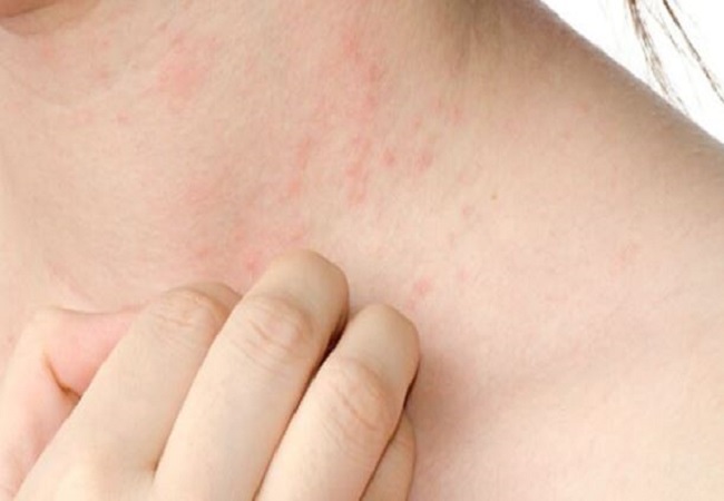 Prickly heat: गर्मियों में सताने लगती है घमौरियों की चिंता, तो इन टिप्स को फॉलो करने से मिलेगा छुटकारा