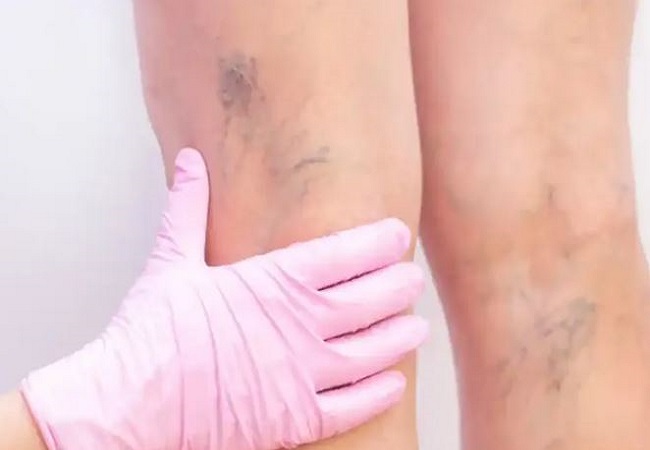 Blocked veins: पैरों की ब्लॉक नसों की वजह से सूजन और दर्द से हैं परेशान, तो फॉलो करें ये टिप्स