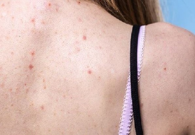 Acne on the back: पीठ पर निकले एक्ने और पिपल्स और दाग धब्बों से हैं परेशान तो फॉलो करें ये घरेलू उपाय