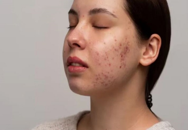 Pimples and acne: चेहरे पर पिंपल्स और एक्ने से हैं परेशान, तो ट्राई करें ये होममेड फेसपैक, कई स्किन प्रॉब्लम्स से मिलेगा छुटकारा