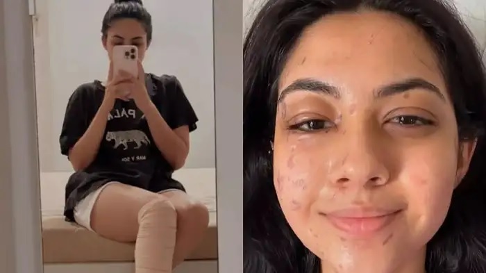 reem shaikh got injured: Reem Shaikh को Laughter Chefs 2 के सेट पर लगी चोट