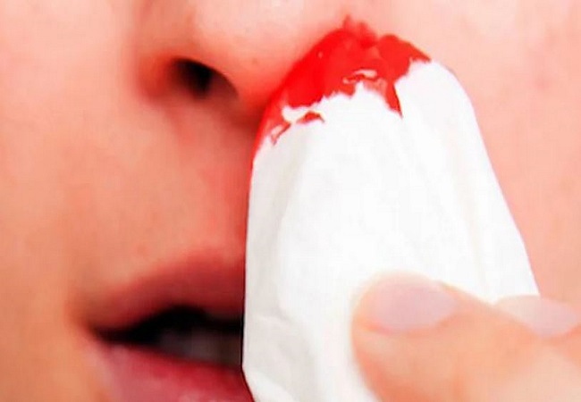 Bleeding from the nose in summer: गर्मियों में क्यों आने लगता है नाक से खून, बचने के लिए फॉलो करें ये टिप्स