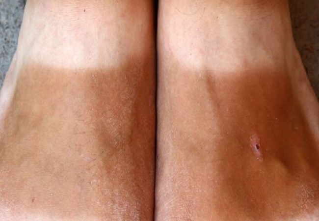 Home remedies to remove tanning of feet: धूप से काले हो रहे पैरों की टैनिंग दूर करने के लिए अपनाएं ये घरेलू नुस्खे