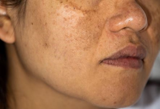 Home remedies: हाइपरपिंंग्मेंटेशन ने छीन ली हैं आपकी खूबसूरती, तो इस समस्या से छुटकारा पाने के लिए फॉलो करें ये घरेलू उपाय