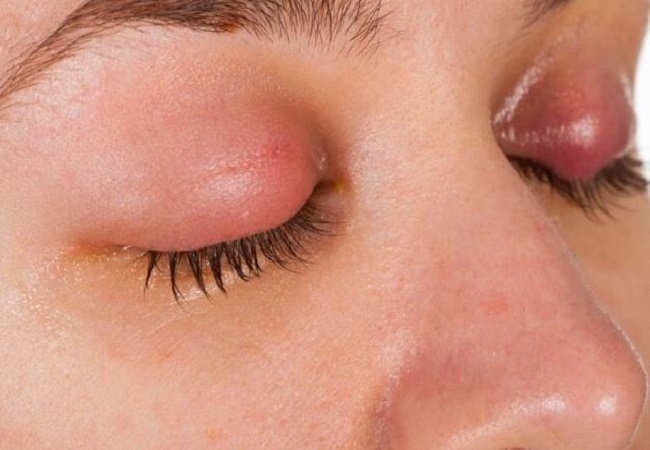 Eye care: गर्मियों में आंखों को रहता है आंखों के इंफेक्शन Conjunctivitis का अधिक खतरा, बचने के लिए फॉलो करें ये टिप्स