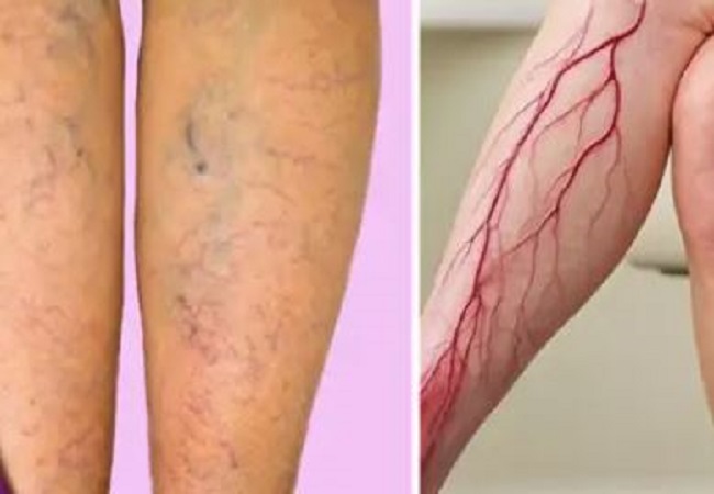 अगर शरीर में दिखे ये लक्ष्ण तो हो जायें अलर्ट नहीं तो कटवाना पड़ेगा ये अंग