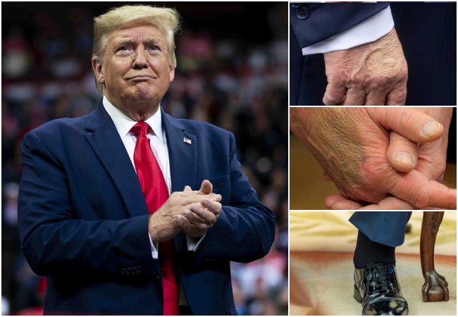 ट्रंप के हाथों पर चोट जैसे निशान और पैरों में सूजन, किस बीमारी से जूझ रहे US राष्ट्रपति? व्हाइट हाउस ने दी हेल्थ रिपोर्ट