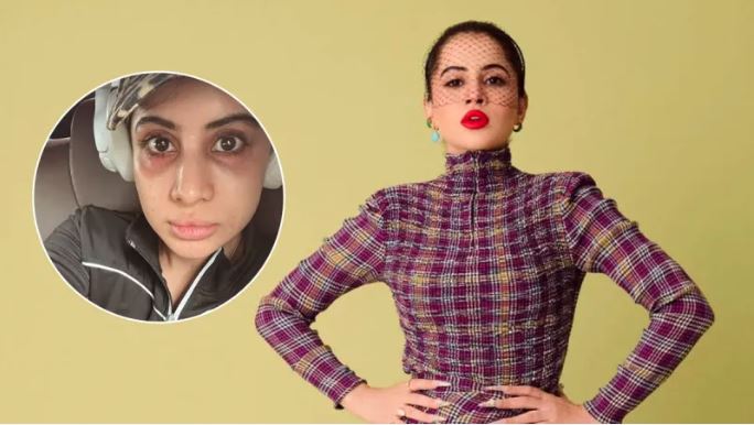 उर्फी जावेद की सूजी हुई आंखें और काले धब्बे से पहचानना हुआ मुश्किल, बोलीं-क्या इस दुनिया में कोई डॉक्टर है, जो मेरा…