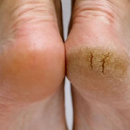 Heel Care Tips : बारिश की मौसम में फटी एड़ियों को आलू करेगा दूर ,ऐसे करें उपयोग