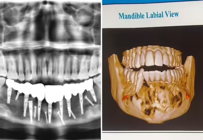 Jaw tumour : मुंह में सूजन-पस लेकर AIIMS पहुंची 24 साल लड़की, रिपोर्ट देख डॉक्टर के उड़े होश