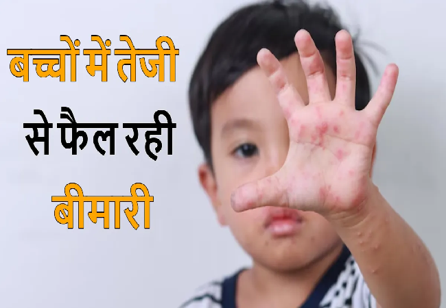 Health Care : गले में खराश और बुखार , मुंह पर दाने, हो सकते हैं हैंड फुट माउथ डिजीज के लक्षण