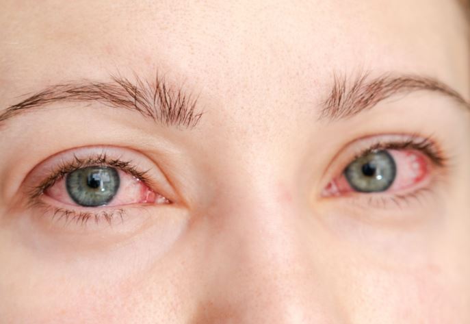 Eye Protection During Changing Weather :  बदलते मौसम में आंखों की सुरक्षा जरूरी  ,  एलर्जी से बचाव ही सबसे बड़ा इलाज