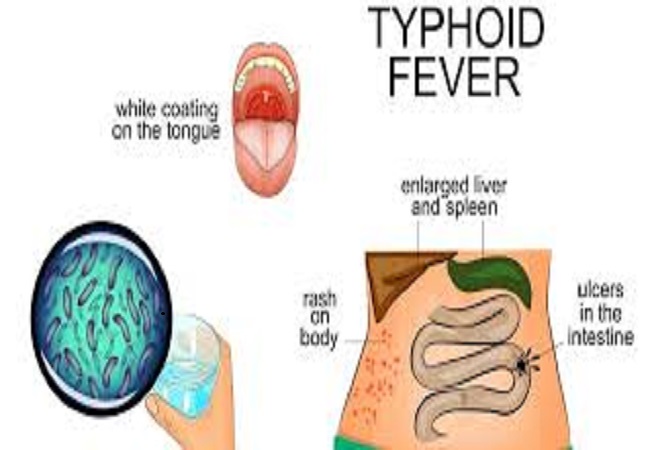 टाइफाइड को जटिल बनाती हे भ्रांतियां, जाने कैसे बचा सकता है बीमारी से