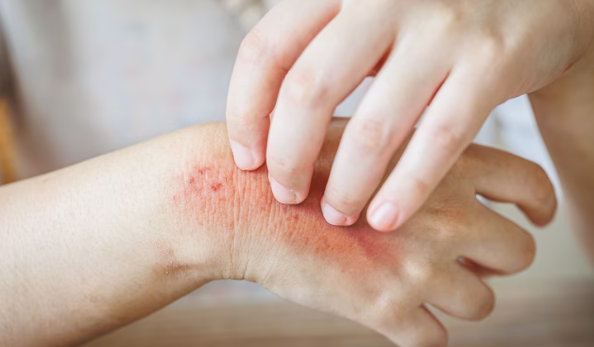 Fungal infections : बारिश में त्वचा का रखें ऐसे ख्याल, फंगल इंफेक्शन का हो सकता है खतरा