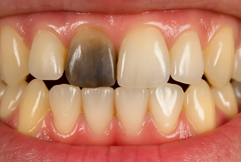 Black spots on teeth :  दांतों में काले धब्बे ऐसे करें साफ? चमक वापस पाने के लिए करें ये काम